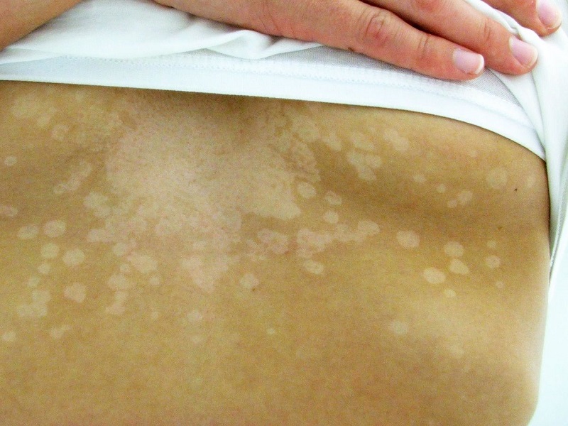 Co warto wiedzieć o grzybicy?