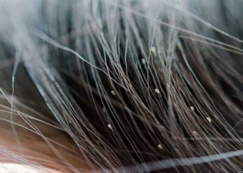 Łuszczyca skóry głowy