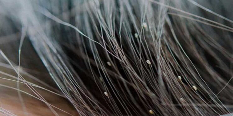 Łuszczyca skóry głowy