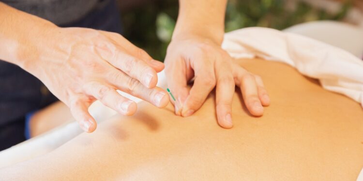 Akupunktura - wszystko co musisz o niej wiedzieć - X-MAG.pl akupunktura